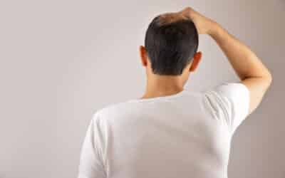 Médicament contre l’ostéoporose stimule la croissance des cheveux : solution à la calvitie