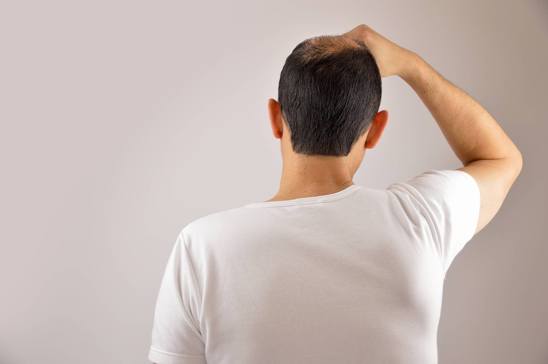 Calvitie : un médicament contre l’ostéoporose fait pousser les cheveux