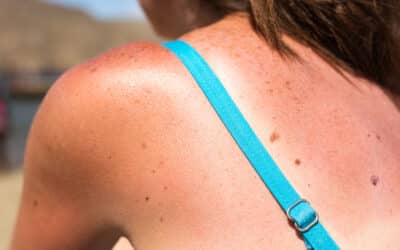 Protéger contre les dangers des UV en été : conseils et précautions